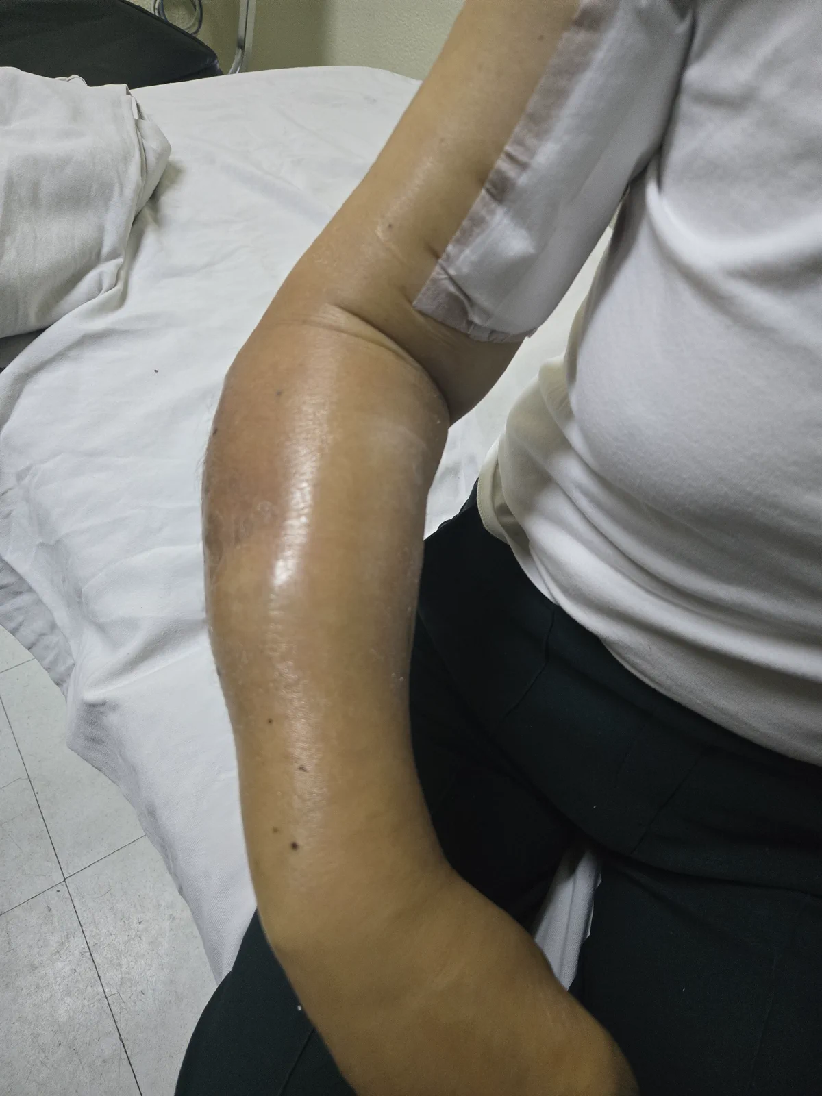 Valoración clínica de edema en una extremidad