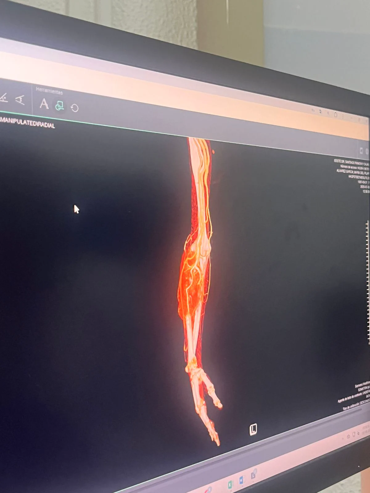 Reconstrucción de angiotomografía vascular en pantalla
